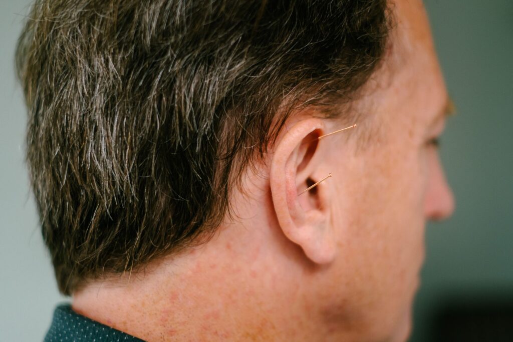 Image o man getting acupuncture on ear.