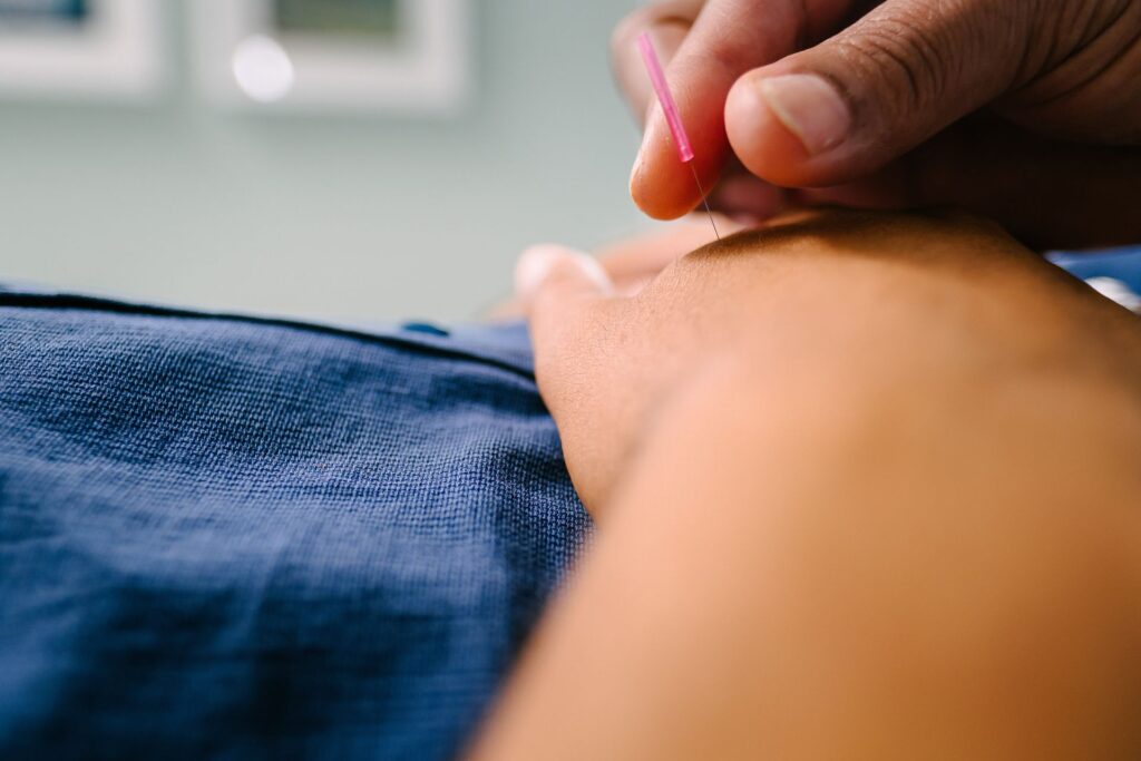 Person getting acupuncture in hand.